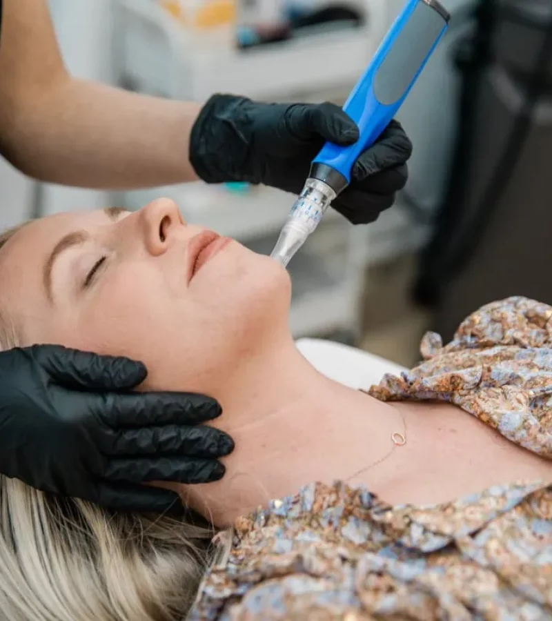 microneedling-in-avabella-aesthetics-at-mount-clemens-mi